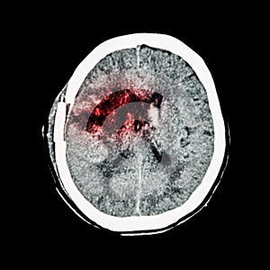 CT scan of brain : show old right basal ganglia hemorrhage with brain edema ( status post craniotomy ) ( Hemorrhagic stroke ) photo