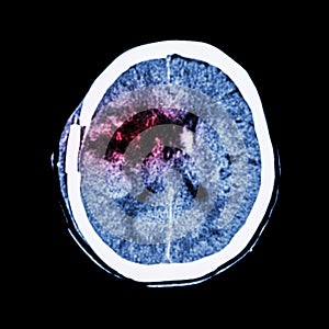 CT scan of brain : show old right basal ganglia hemorrhage with brain edema ( status post craniotomy ) ( Hemorrhagic stroke ) photo