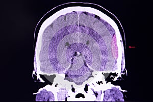 Brain CT scan, epidural hemorrhage photo