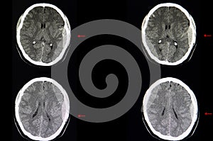 Brain CT scan, epidural hemorrhage photo