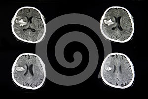 CT scan of a brian of a patient with acute hemorrhagic stroke