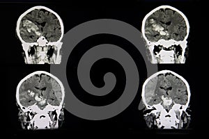 CT scan of a brian of a patient with acute hemorrhagic stroke