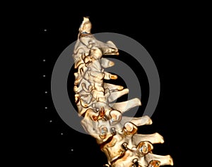 CT scan of C-Spine or Cervical spine