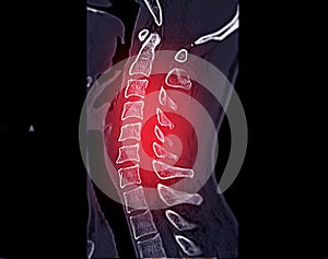 CT scan of C-Spine or Cervical spine