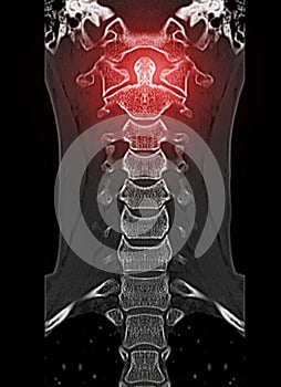 CT scan of C-Spine or Cervical spine