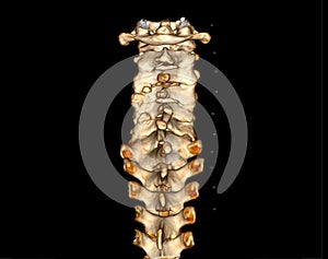 CT scan of C-Spine or Cervical spine 3D rendering