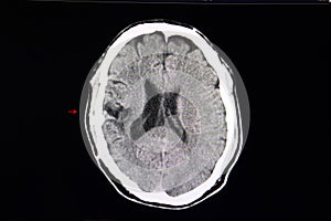 CT scan cerebro malacia