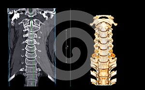 CT SCAN of Cervical Spine C-spine .