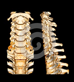 CT SCAN of Cervical Spine C-spine