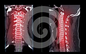 CT SCAN of Cervical Spine C-spine