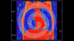 CT scan of Chest coronal view in color mode  for diagnostic Pulmonary embolism (PE) , lung cancer and covid-19