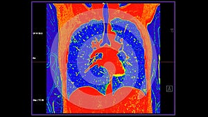 CT scan of Chest coronal view in color mode  for diagnostic Pulmonary embolism (PE) , lung cancer and covid-19