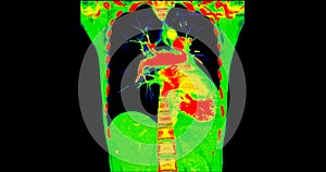 CT scan of Chest coronal view in color mode  for diagnostic Pulmonary embolism (PE) , lung cancer and covid-19