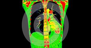 CT scan of Chest coronal view in color mode  for diagnostic Pulmonary embolism (PE) , lung cancer and covid-19