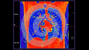 CT scan of Chest coronal view in color mode  for diagnostic Pulmonary embolism (PE) , lung cancer and covid-19