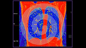 CT scan of Chest coronal view in color mode  for diagnostic Pulmonary embolism (PE) , lung cancer and covid-19