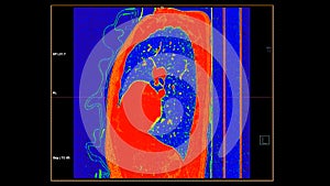 CT scan of Chest coronal view in color mode  for diagnostic Pulmonary embolism (PE) , lung cancer and covid-19