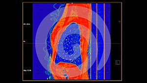 CT scan of Chest sagittal view in color mode  for diagnostic Pulmonary embolism (PE) , lung cancer and covid-19