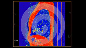 CT scan of Chest sagittal view in color mode  for diagnostic Pulmonary embolism (PE) , lung cancer and covid-19