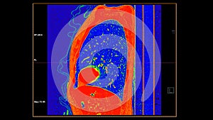 CT scan of Chest sagittal view in color mode  for diagnostic Pulmonary embolism (PE) , lung cancer and covid-19