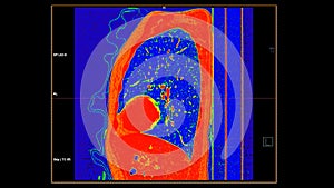 CT scan of Chest sagittal view in color mode  for diagnostic Pulmonary embolism (PE) , lung cancer and covid-19