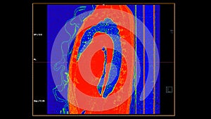 CT scan of Chest sagittal view in color mode  for diagnostic Pulmonary embolism (PE) , lung cancer and covid-19