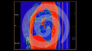 CT scan of Chest sagittal view in color mode  for diagnostic Pulmonary embolism (PE) , lung cancer and covid-19