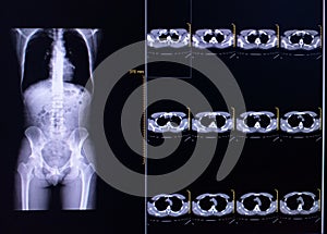 CT Scan chest and thorax there is no pulmonary infiltration.The heart and great vessels are unremarkable.Intact osseous structure.