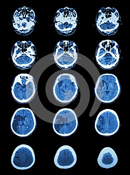 CT scan (computed tomography) of brain show cerebral infarction