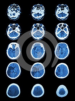 CT scan (computed tomography) of brain show cerebral infarction photo