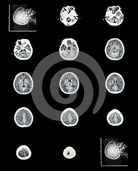 CT scan (computed tomography) of normal brain ( cerebrovascular