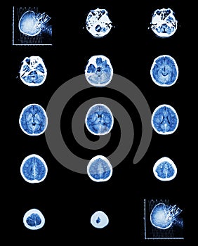CT scan (computed tomography) of normal brain ( cerebrovascular
