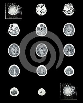 CT scan (computed tomography) of normal brain ( cerebrovascular photo