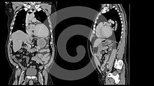 CT Scan  Computed tomography  of whole abdomen with contrast. Coronal and Sagittal view presented with clinical history of cervi