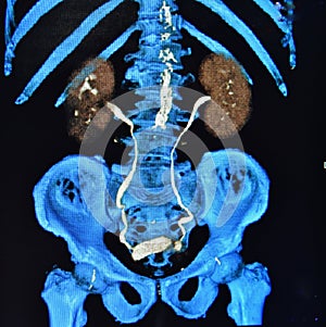 Ct scan 3d ct urography kidneys bladder colorful