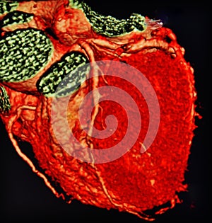 Ct scan 3d heart angiography colorful photo