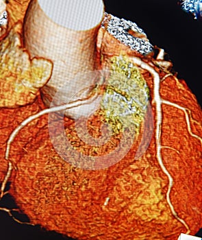 Scannerizzare  tridimensionale cuore angiografia colorato 