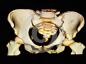 CT-scan 3D Pelvis photo