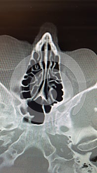 CT scan of the ethmoid sinus air cells