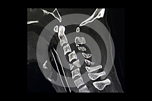 CT scan of fractures cervical spines