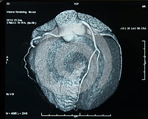 CT-Scan Heart photo