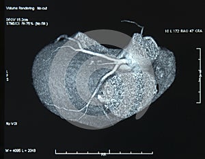 CT-Scan Heart