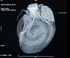 CT-Scan Heart