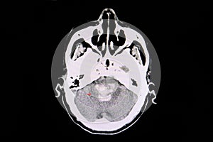 CT scan hemorrhagic stroke