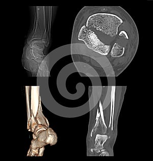CT Scan image of Left Ankle Shown fracture of Left Ankle . photo