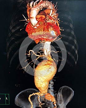 Abdominal aortic aneurysm photo