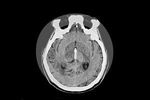 CT scan intracerebral hemorrhage