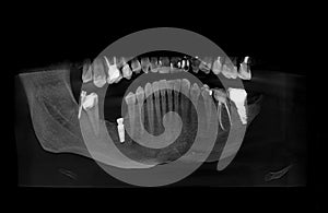 CT scan of the jaw with dental pin and missing tooth in four planes