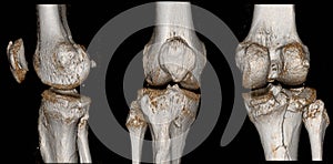 CT scan knee Fracture of intercondylar eminence of tibia. Compression fracture of posterior of lateral tibial plateau which photo