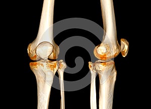 CT Scan of  Knee joint 3D rendering Showing fracture of Patella